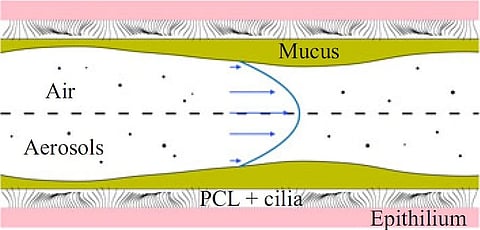 A diagrammatic representation of middle air pathways of lungs, showing mucus blockade. 