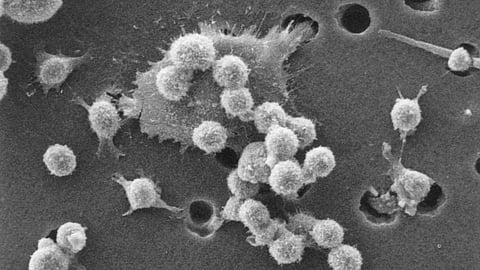 Microscopic view of cancer cells showing clustered, spiky shapes on a textured surface.