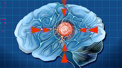 Illustration of a human brain with red arrows pointing to a central tumor.