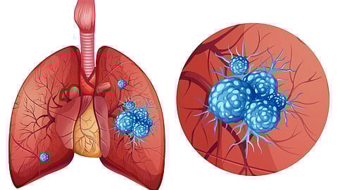 Illustration of human lungs with a detailed inset showing blue cancer cells on a red background