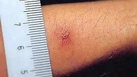Eschar, red colored lesion fromed after the larvae bite, in the left arm of patient with scrub typhus.