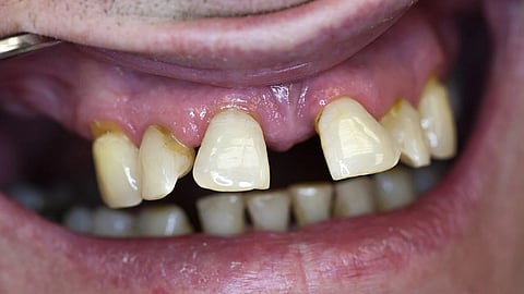 Swollen gums and loose teeth. 