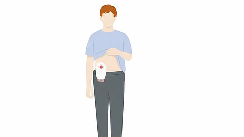 Drawing of an ostomy bag placed on a person.