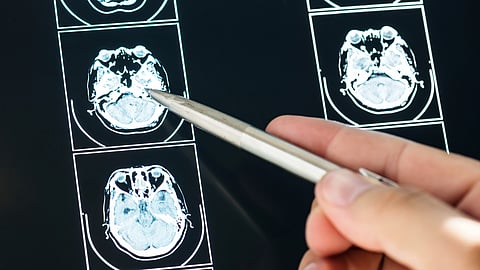 A hand holds a pen pointing at brain MRI scans on a screen.