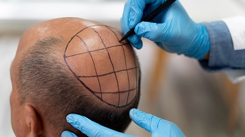 A bald man getting mapped for hair treatment.