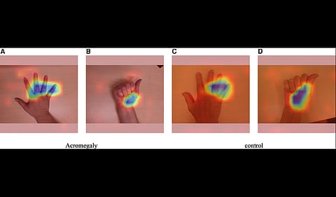 Hand images being analyzed by AI tools for detecting acromegaly.