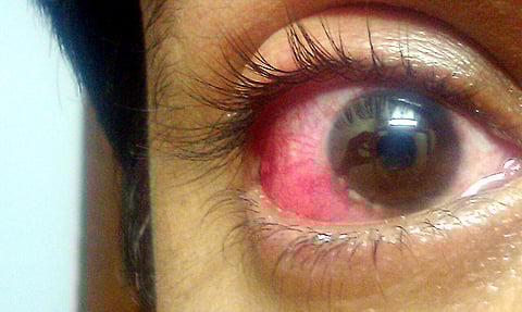 Viral conjunctivitis
