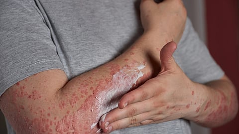 A person applies cream to red, scaly patches on their forearm.