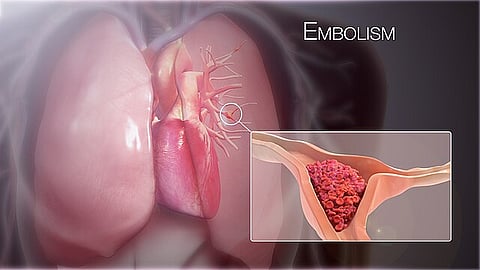 3d animation of a pulmonary embolism.