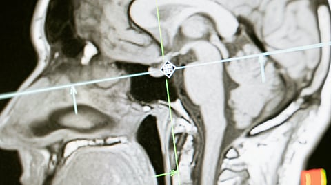 MRI scan of a human head in profile.