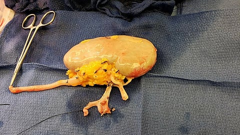Kidney removed from live donor and transplanted 
