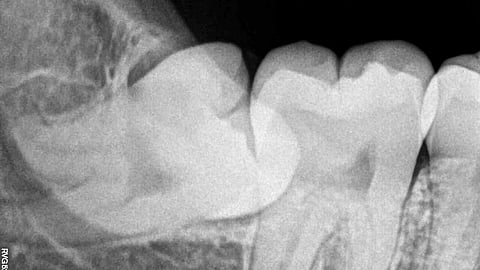 A dental X-ray showing an embedded wisdom tooth. 