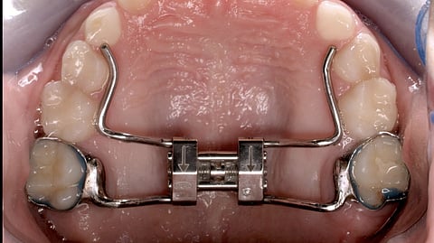 Hyrax palatal expander attached on the upper arch of the patient inside the mouth, the metal parts, crews all visible. 