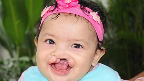 A baby girl with cleft lip