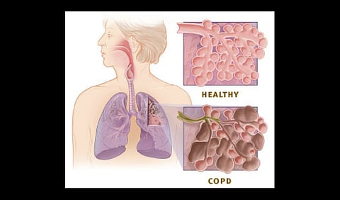 Comparison of healthy lung versus COPD lung