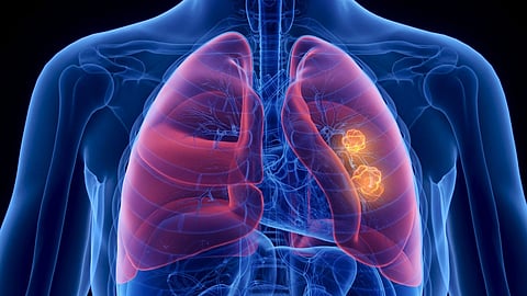 Lungs inside the chest with small tumor growths in the right lung representing abnormal growths in lung tissue in a clear way.