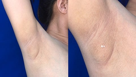 Clinical presentation of ectopic breast tissue with milky secretions in the axillary region. 