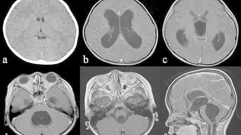MRI of a tetraventricular hydrocephalus in a 3-year-old boy with an idiopathic fourth ventricle outlet syndrome.