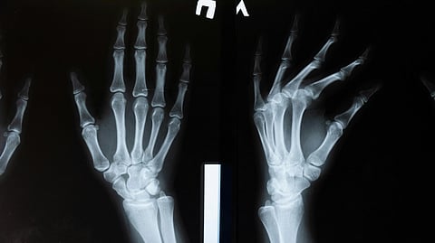 X-ray image of two hands, showing bones in detail.