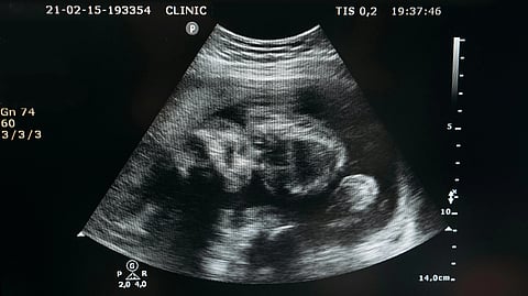 An ultrasound image showing a developing fetus in black and white. 