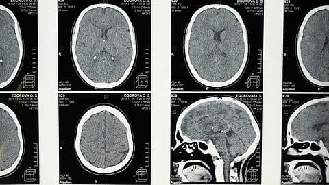 MRI scan image showing multiple cross-sectional brain views.