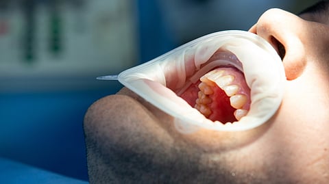 Close-up of a dental check-up with a mouth guard in place.