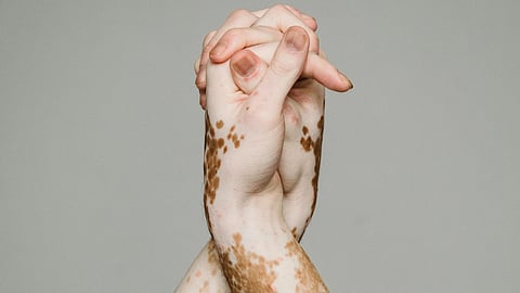 Two hands with vitiligo clasped together, showing unity and acceptance.