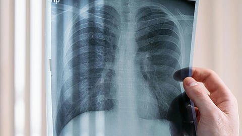A hand holds a chest X-ray film against a softly lit background with vertical blinds.