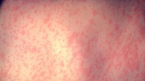 Close-up of a skin rash with even red spots across a light skin surface.