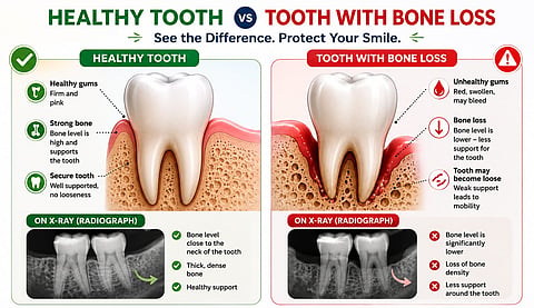 Side-by-side comparison of a healthy tooth and a tooth with severe bone loss, including illustrations and radiographs showing reduced bone support.