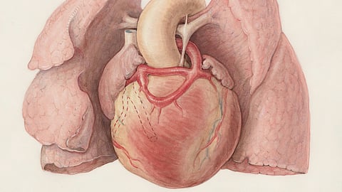 A human heart with a cardiac catheter used to represent structural heart disease and interventional cardiology.