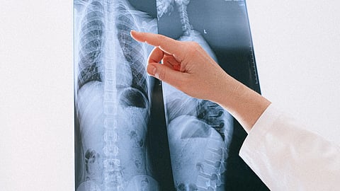 A person displaying a chest X-ray image, highlighting the lungs and heart.
