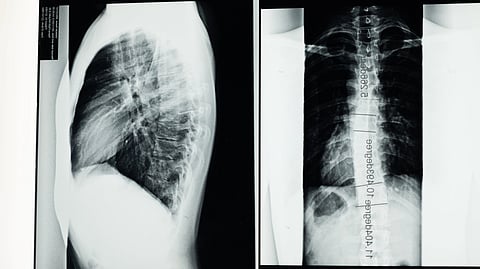 A chest X-ray showing front and side views of the lungs and bones.