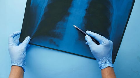 Gloved hands point at a chest X-ray with a pen.