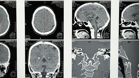 Black-and-white brain CT scans showing different cross-sectional views of the head.