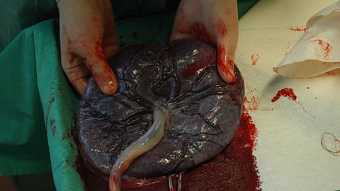 Gloved medical hands hold a freshly delivered placenta.