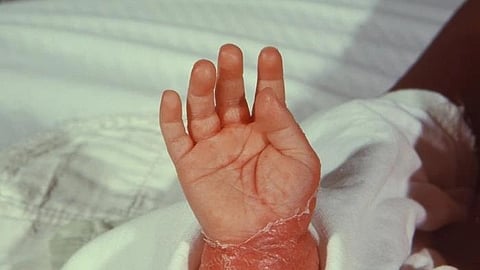 A baby's small hand with peeling skin rests on a white blanket.