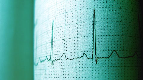 ECG strip showing a heart rhythm pattern on grid paper.