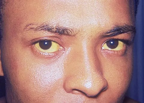 Close-up of a patient's eyes showing yellow discoloration of the sclera and conjunctiva caused by jaundice