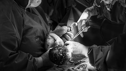 Illustration of C-section delivery shown in the operation theater