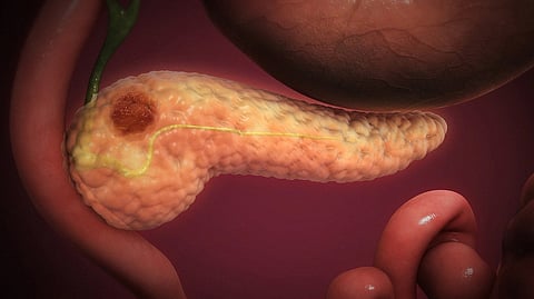 Pancreatic cancer
