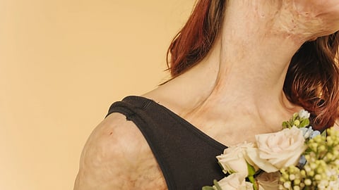 Inflammation on arm and neck due to lupus