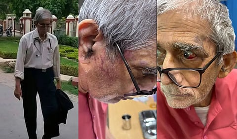 Dr. T. K. Lahiri's face showing bruises and red eye. 