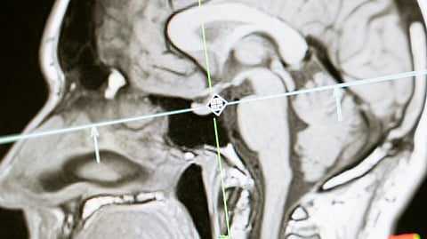 Brain Scan