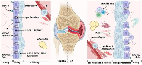 Synovial membrane architecture of the healthy (left) and osteoarthritic joint (right). The healthy synovium comprises a thin lining layer with barrier-forming CX3CR1+ TREM2+ MERTK+ resident macrophages (type A synoviocytes) and CD55+ PRG4+ THY1− fibroblasts (type B fibroblast-like synoviocytes). The lining layer separates the synovial cavity from the tissue. The sublining layer hosts various fibroblast and macrophage populations, adipocytes, and blood vessels. During osteoarthritis, the integrity of the barrier, maintained by tight junctions of resident macrophages, is disrupted in the lining layer. Figure was created with BioRender.com
