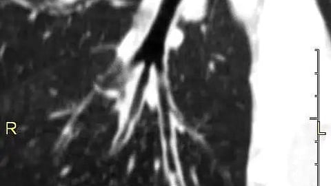 scan showing primary ciliary dyskinesia