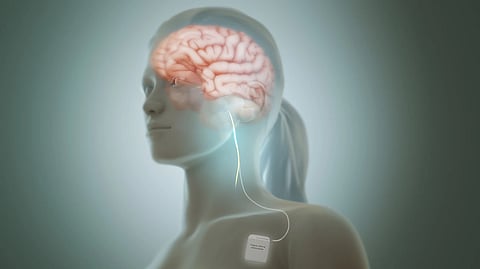 illustration of Vagus nerve simulation 
