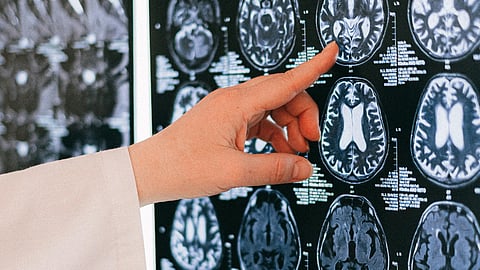 health practitioner pointing towards a brain scan 