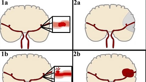 Illustration of ischemic stroke. 