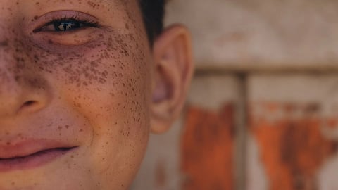 Close up of a child with measles and smiling 